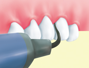 ① 歯垢・歯石の除去