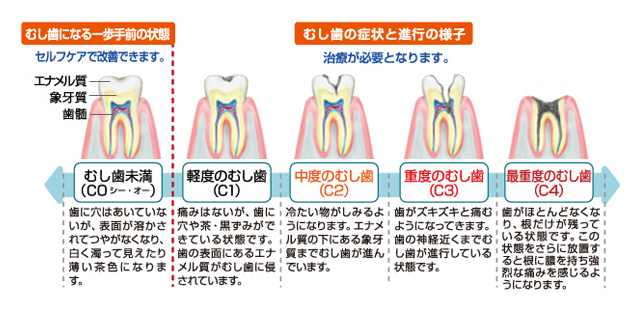 むし歯の進行