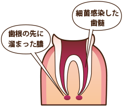 ①細菌感染した歯髄。歯根の先に溜まった膿。