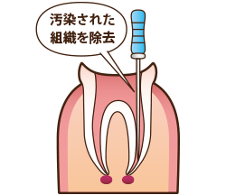 ②汚染された組織を除去