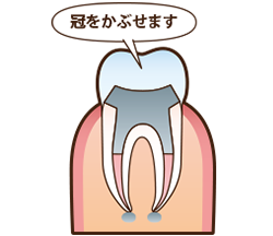 ⑥冠をかぶせます